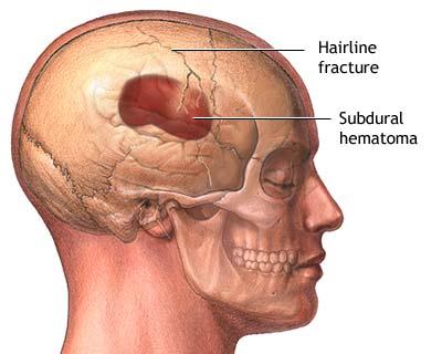 head injury