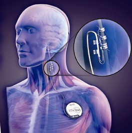 Vagal Nerve Stimulation